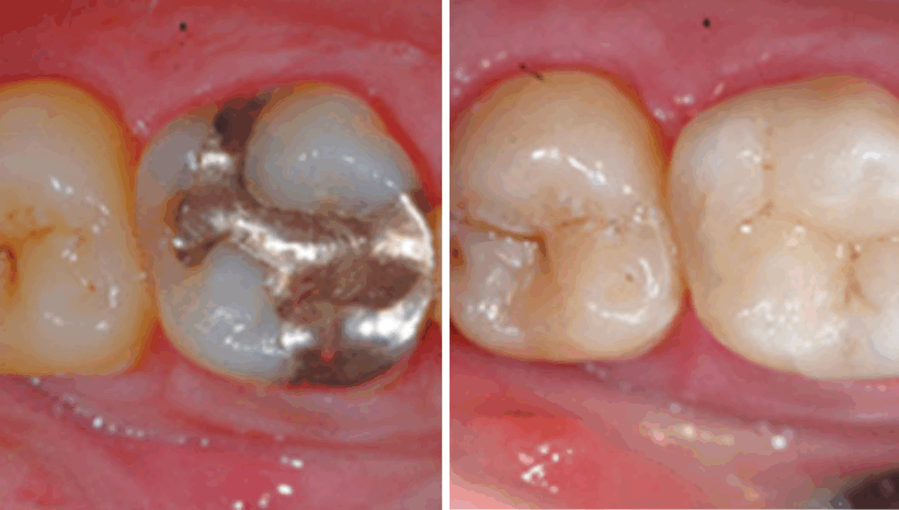 CEREC Restoration