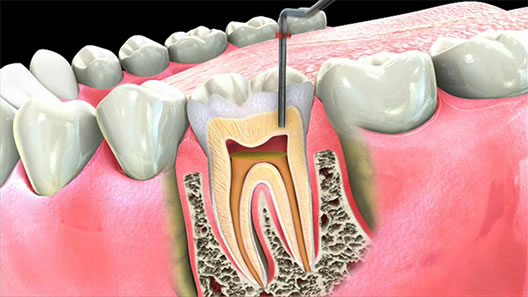 Root Canals By The Experts In South Boston Tremont Dental