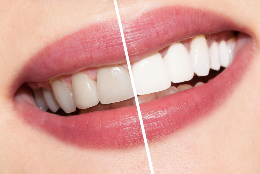 teeth-whitening Different Methods of Bleaching