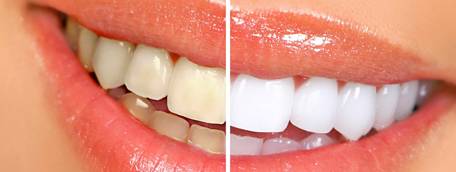 South End Boston Dentists Explain: What is Zoom Teeth Whitening