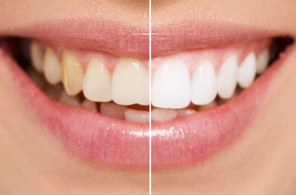 Is Zoom Teeth Whitening Procedure Painful