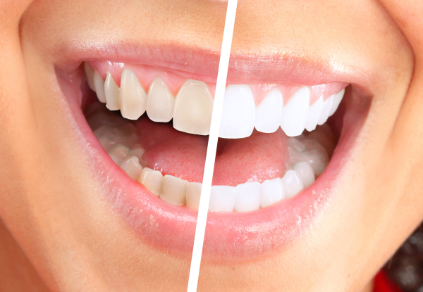 What Are the Side Effects to Zoom Teeth Whitening Treatment