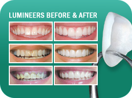 Lumineers Advice From Tremont Dental Boston Massachusetts