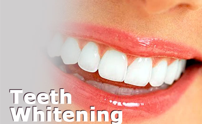Teeth Whitening Methods – Which Method Should You Use?