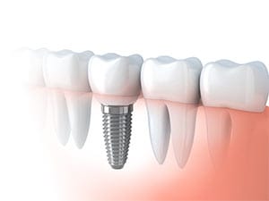 Dental Implant Dentist In Southend Boston Massachusetts - What Are Dental Implants?