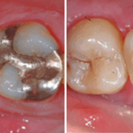 CEREC Restoration