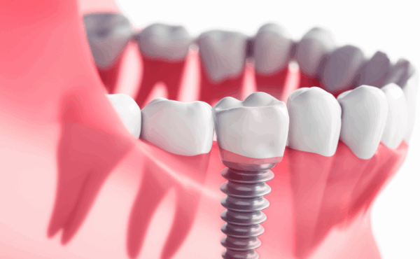 Dental Implants
