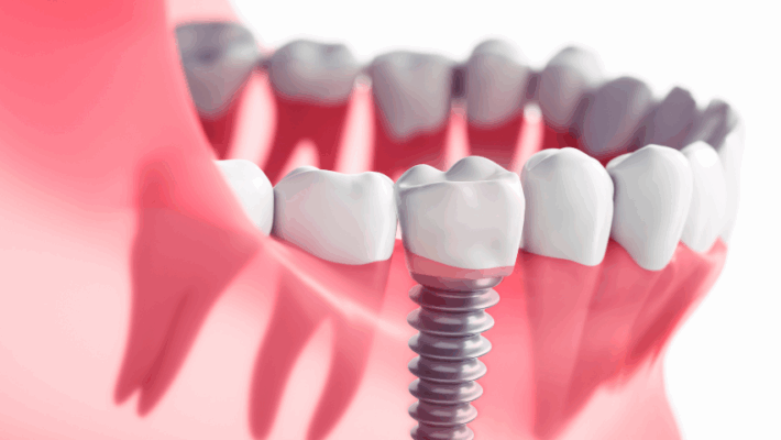 Dental Implants