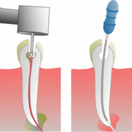 Root Canals