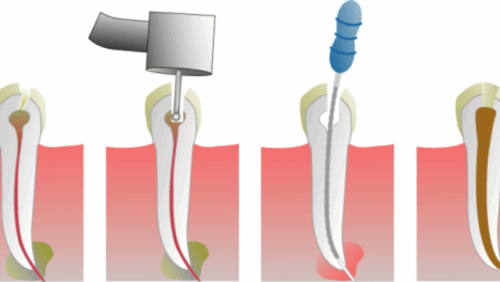 Root Canals