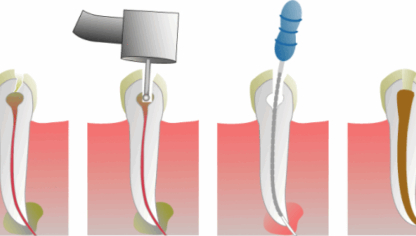 Root Canals