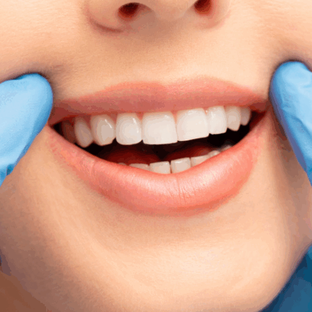Tooth Whitening