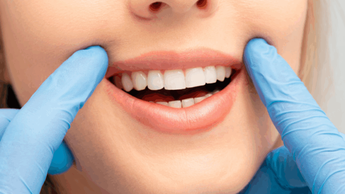 Teeth Whitening Services In Boston Massachusetts
